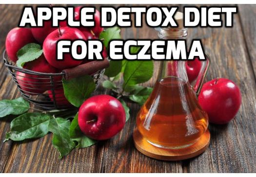 Apple Detox for Preventing Future Eczema Outbreaks - Do you know that apple detox can increase the effectiveness of your eczema treatment? Read on to find out how you can start this apple detox program to prevent future eczema breakouts.