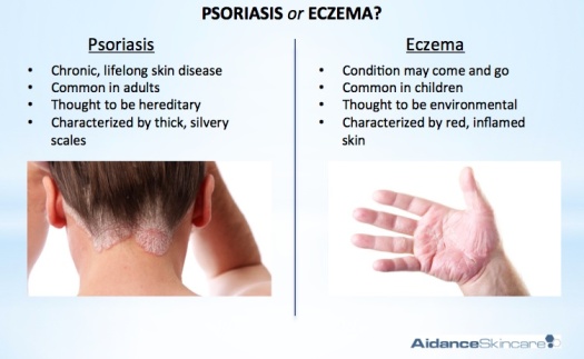 Eczema and Psoriasis – What’s the Difference? Over the years, eczema and psoriasis have been referred interchangeably, which have somehow blurred the difference. In order to come up with an effective treatment, you need to know if you are suffering from eczema or psoriasis. Read on to understand the differences between eczema and psoriasis.
